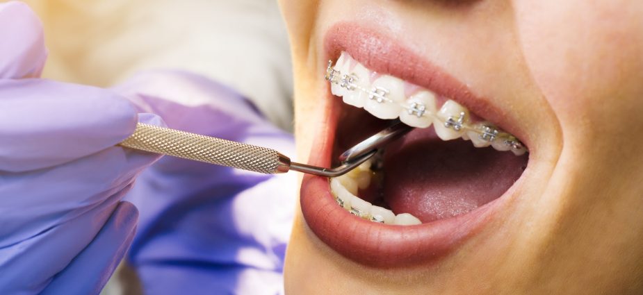 The Journey to a Perfect Smile: OrthoSquare’s Guide to Orthodontic Treatments
