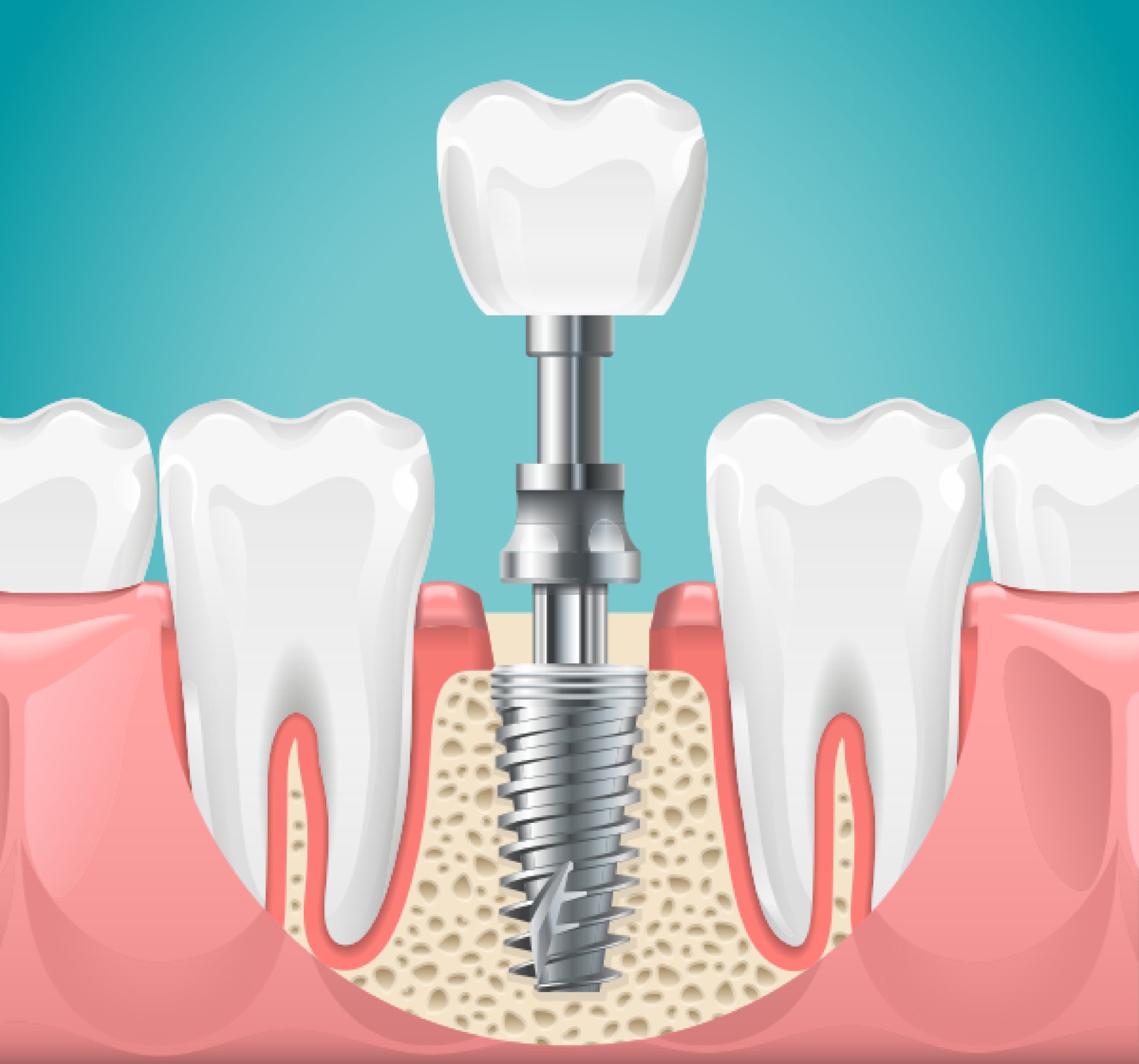 Discovering the Magic of Dental Implants: OrthoSquare’s Effective Approach