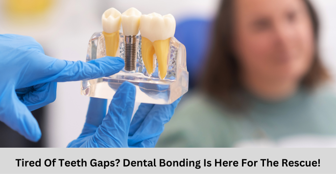 Tired Of Teeth Gaps? Dental Bonding Is Here For The Rescue!