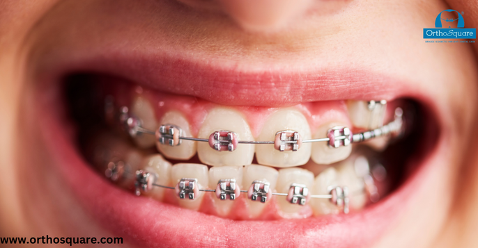 Different Types Of Braces And How To Choose The Right One For You?