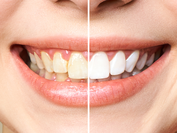 orthosquare teeth whitening