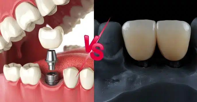 Dental implant 