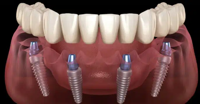 Dental implant 