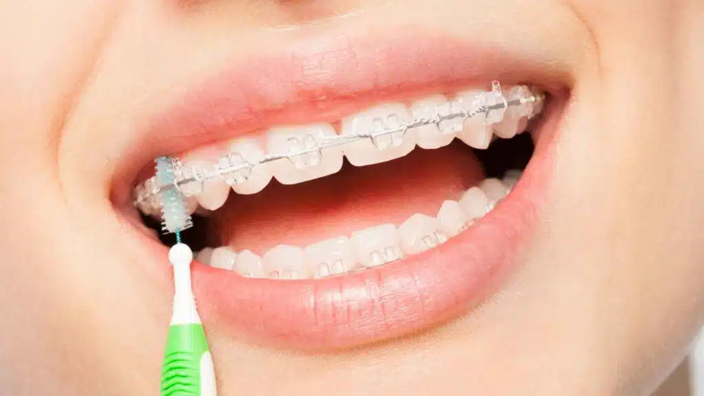Dental implant 