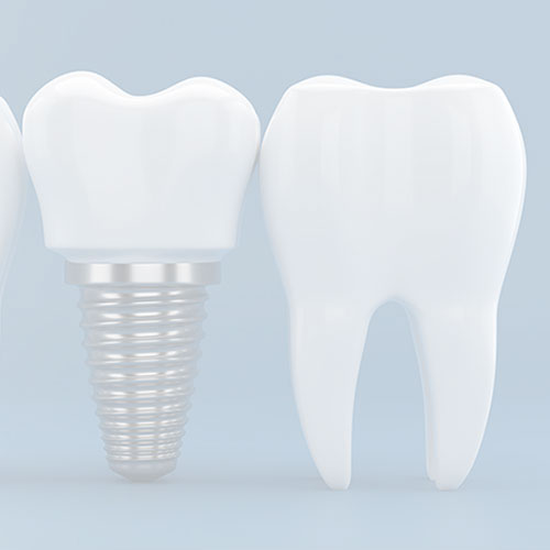 orthosquare crown and Bridges