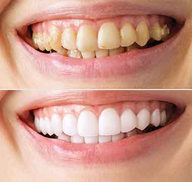 orthosquare teeth whitening