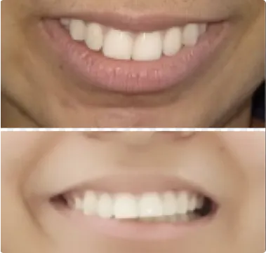 orthosquare teeth braces