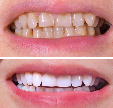 orthosquare teeth braces