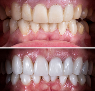 orthosquare teeth braces