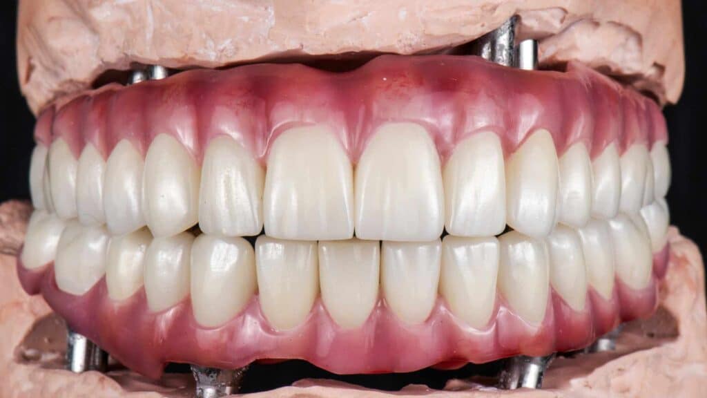 full mouth dental implants