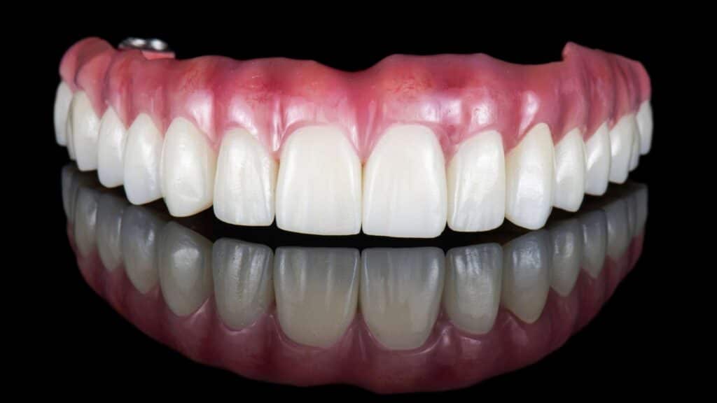 full mouth dental implants