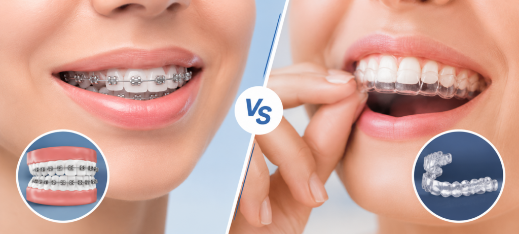 difference between braces and aligners