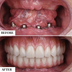 Before and after case 4
