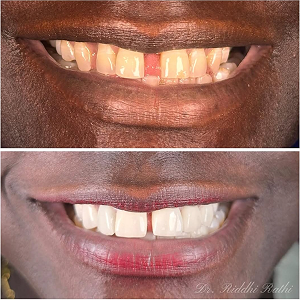 Before and after case 6