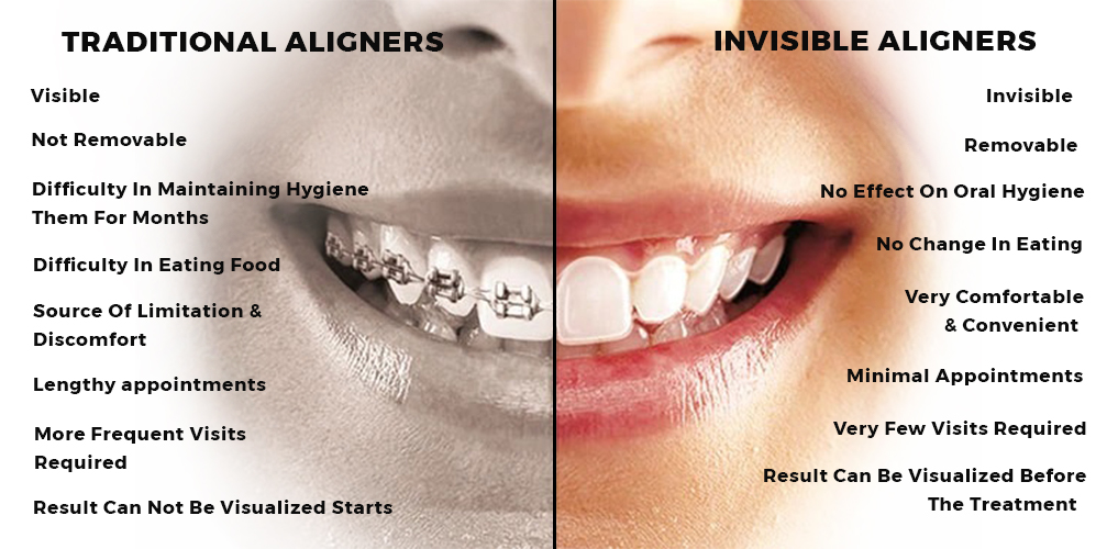 Invisible and Clear Aligners Treatment for Teeth | Invisible Braces ...